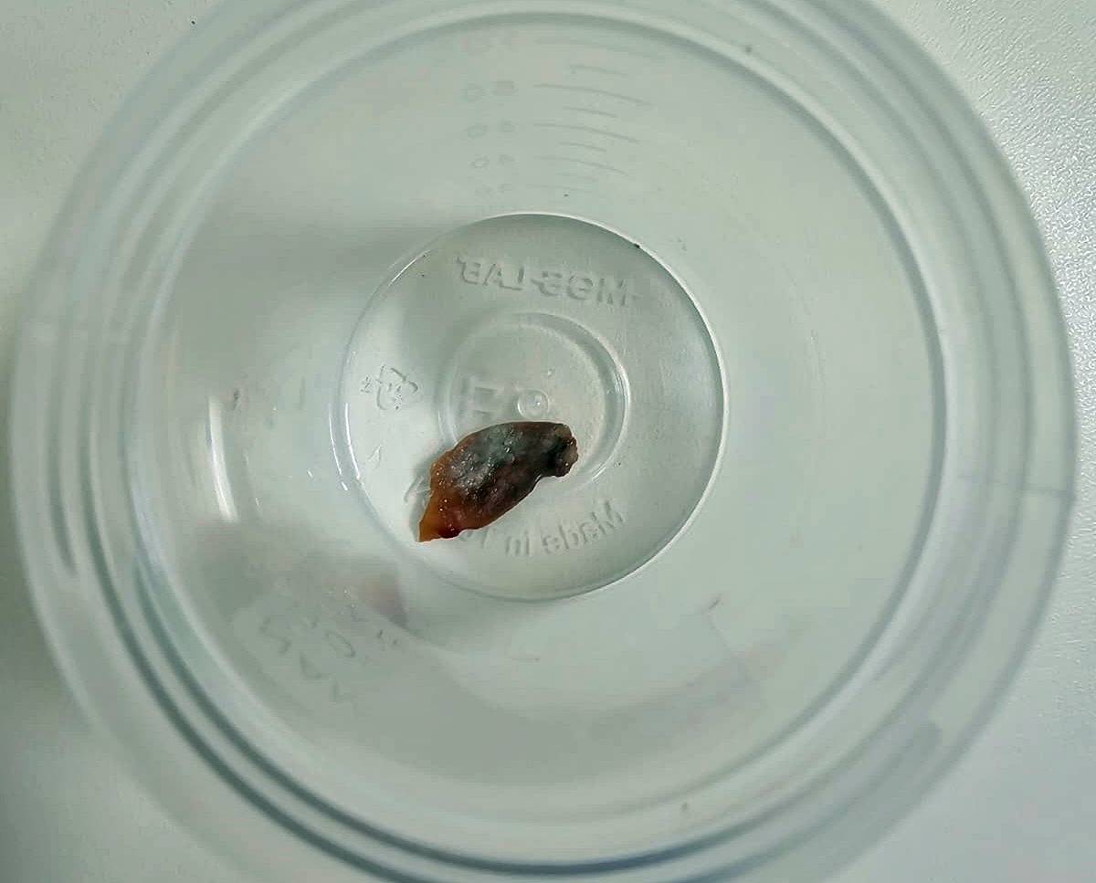 kansersin-astimsin-dediler-akcigerinden-kabak-cekirdegi-cikti-4