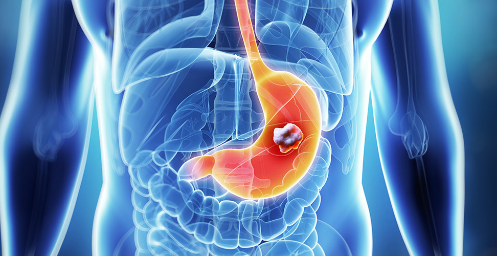 3d-render-of-stomach-cancer-700x500-1-1.jpg