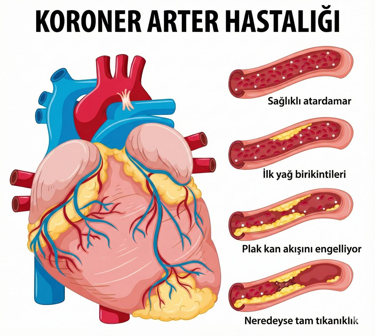 koroner-arter-hastaligi-nedir.jpg