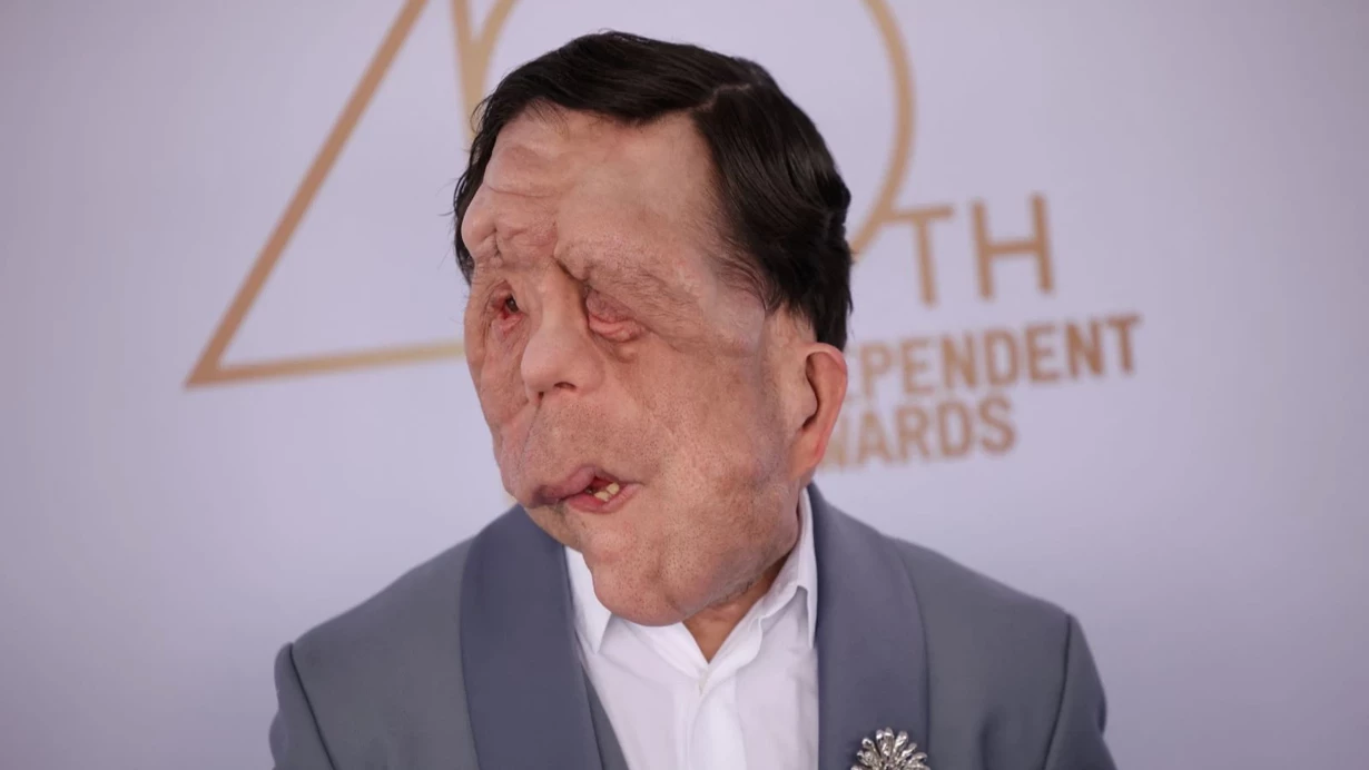 adam-pearson-ve-ikizi-ayni-hastalik-ikisini-farkli-etkiledi-v3sx.webp