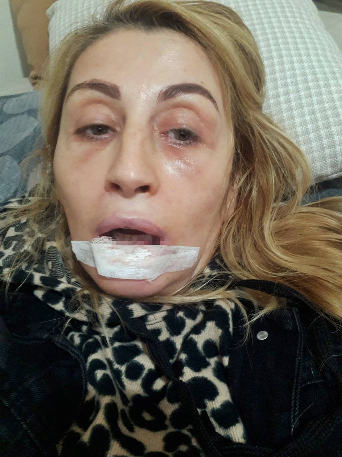 estetik-sonrasi-dudagi-curuyen-kadin-songul-uzunoglu-5.jpg