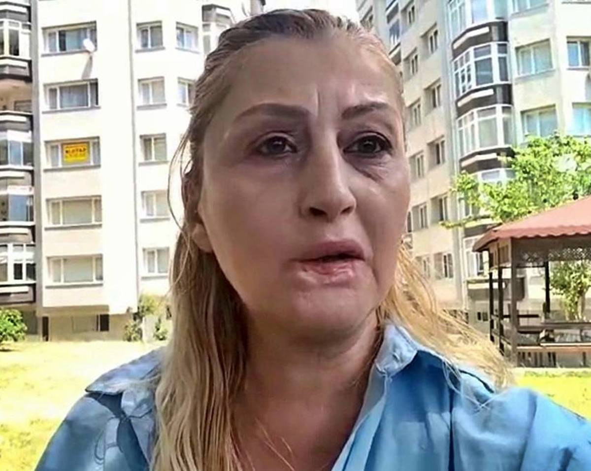 estetik-sonrasi-dudagi-curuyen-kadin-songul-uzunoglu-6.jpg