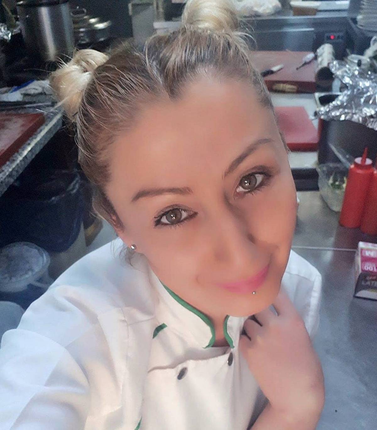 estetik-sonrasi-dudagi-curuyen-kadin-songul-uzunoglu-7.jpg