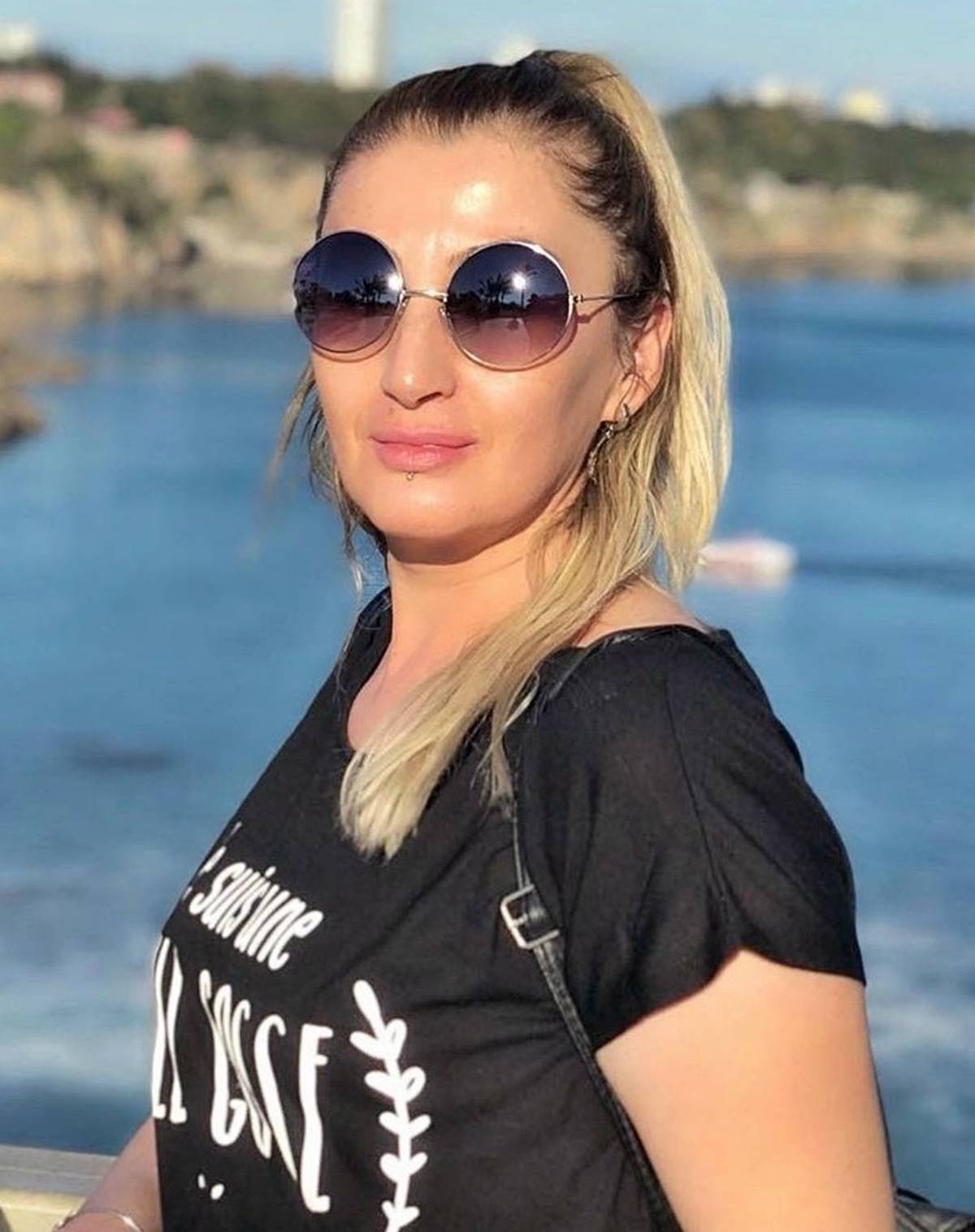 estetik-sonrasi-dudagi-curuyen-kadin-songul-uzunoglu-8.jpg