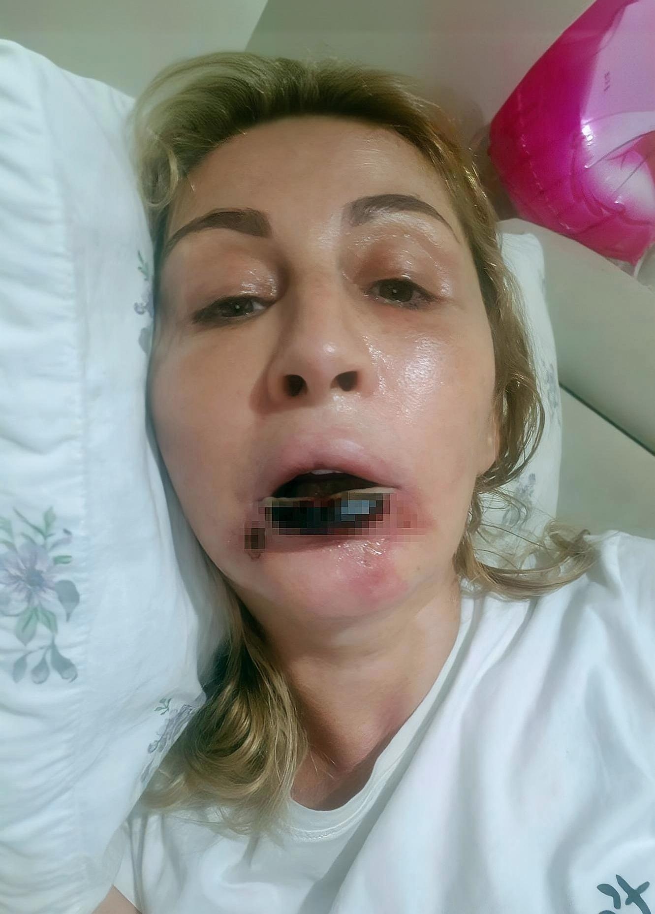 estetik-sonrasi-dudagi-curuyen-kadin-songul-uzunoglu-9.jpg