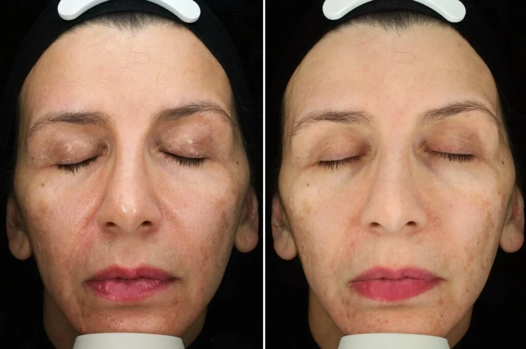 retinoid-tedavisi-oncesi-sonrasi-3.webp