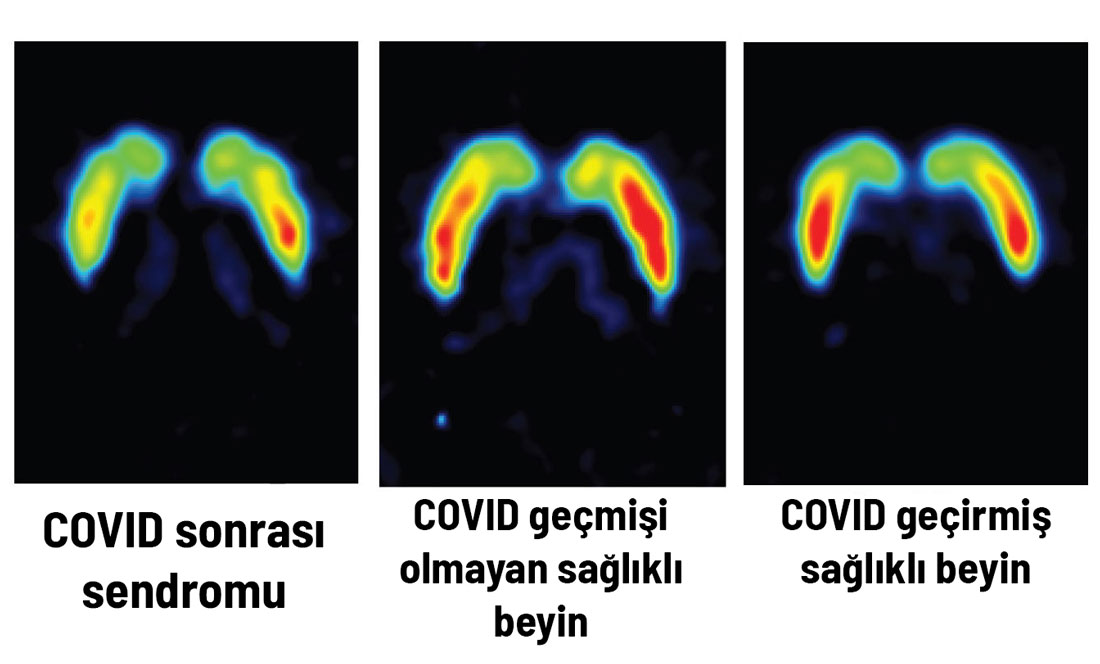 beyin-taramalari-covid-hasarini-desifre-etti-atif-pano-001.jpg